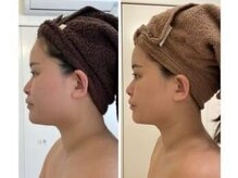 美人バスト 本厚木店/【小顔コルギ】☆症例