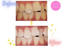 エクシアホワイトニング 心斎橋店/ホワイトニングビフォーアフター