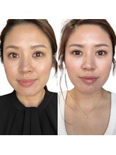 マヴィ 香里園店(MavY.)/ハーブピーリング翌日の透明感