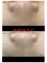 エスティ 京都店/皮脂の詰まりbefore/after