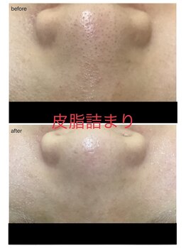 エスティ 京都店/皮脂の詰まりbefore/after