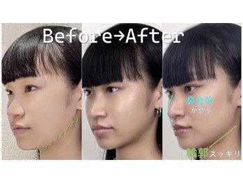 ラプリ 横浜店(Raplit)/ 隆鼻+輪郭矯正40分