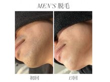 エミナル(EMINAL)/MEN'S ヒゲ脱毛