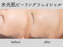 マーベル(MaaBelle)/20代/水光肌ピーリング