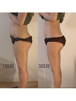 シーアイエステティック 船橋駅前店(c.iエステティック)/ブライダル痩身