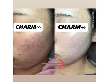 チャーム(CHARM∞)/ニキビケア