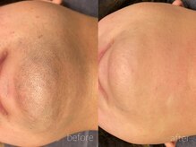 オンセ(once)/顔脱毛/全身脱毛