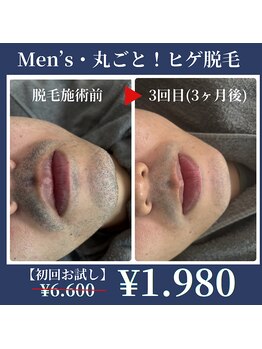 ビヌ(Binu)の写真/ヒゲ剃り0分へ！脱毛でヒゲが抜け落ちる喜びを！シェービングによる肌荒れ解消で自信UP！☆