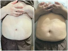 フォーユー整骨院 中島院(foryou整骨院)/ラジオ波の効果絶大！！