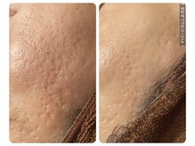 プレシャスサロン(precious salon)/3ヶ月の変化～凹肌～