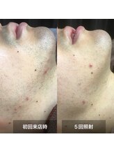 リムル(REMURU)/ひげ脱毛5回照射