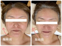 キーオブフェイス(Key of Face)/お悩み【お顔のたるみ】