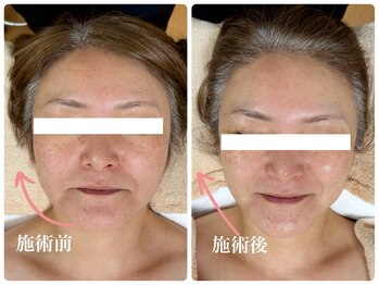 キーオブフェイス(Key of Face)/お悩み【お顔のたるみ】