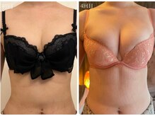 美人バスト 本厚木店/バストアップ◇症例◇