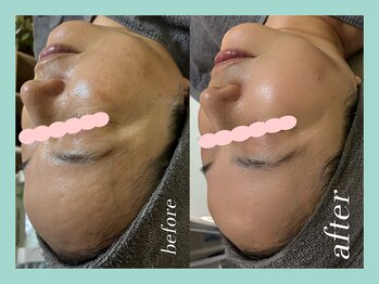 ミウル 天王寺店(miulu)/シミ照射