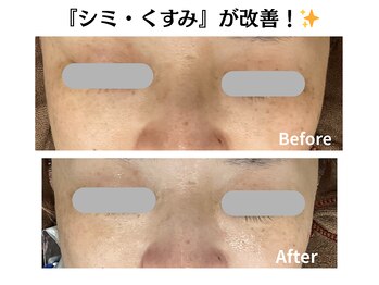 グレースティー 森町 箕面/シミ・くすみ★薄く改善！！