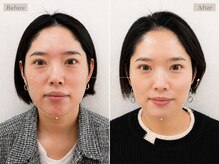 ブプラ 藤が丘店(BUPURA)/即日実感！驚愕の小顔効果！
