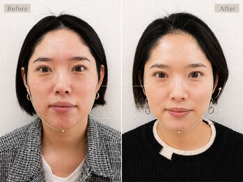 ブプラ 藤が丘店(BUPURA)/即日実感!驚愕の小顔効果!