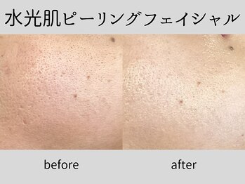 マーベル(MaaBelle)/30代/水光肌ピーリング