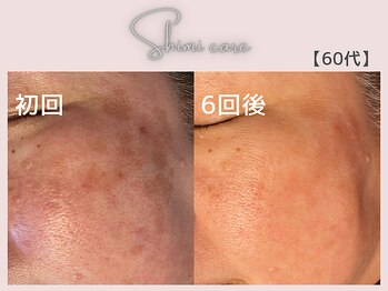 美シェリ(美Cheri)/シミケアビフォーアフター