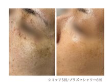 ルーム(room)/シミケア5回＋シャワー6回