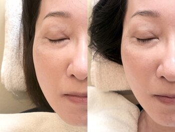 アカシア鍼灸整骨院の写真/~健康的に美しく~メイクしたままOK◎【美容鍼灸】と【表情筋トレーニング】でお顔のお悩みを根本改善!