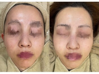 スターラッシュ(Star Lash)/全顔美肌脱毛ビフォーアフター