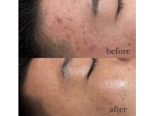 エムラヴィ(M Lavie)/本気の肌質改善ハーブリプロ