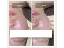 スムース(smooth)/フェイシャル：角質毛穴ケア