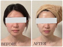 イリゼ(IRISER)/【20代小顔】小顔＆艶肌に！