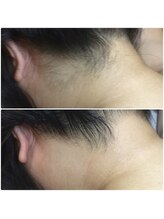 カルム(Calme)/うなじ脱毛