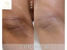 ハーブのほし/脇の黒ずみ・色素ケア
