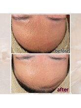 プルーム 久留米店(plume)/ハーブピーリング