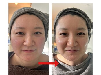 オリファインサンサン(Orefine33)/ニキビが気になる方も健康に肌育