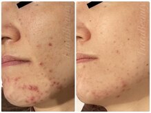 今まさにできてしまったニキビケアに！最新プラズマをW照射で◎