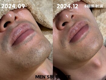 ルーチェ/【ヒゲ脱毛】髭剃り時間が短縮!