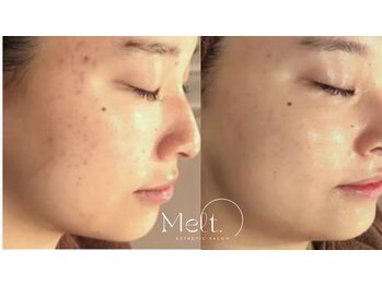メルト 中目黒(Melt.)/*厳選国産ハーブピーリング