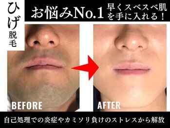 ジェントルメンズグロー(Gentlemen’s Glow)/【ヒゲ脱毛】