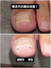 巻き爪じゅん 千葉駅前店/巻き爪の痛みで悩みの方が笑顔に