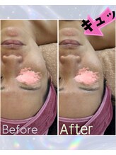 カシェボーテ(CACHE BEAUTE)/半顔リフトアップ