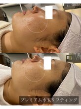 バイハル 原宿表参道(by HARU)/ビフォーアフター