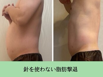ソルニス(Solnis.)/痩身☆脂肪分解/ハイパーナイフ