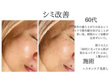 シャルナ(charna)/シミ改善