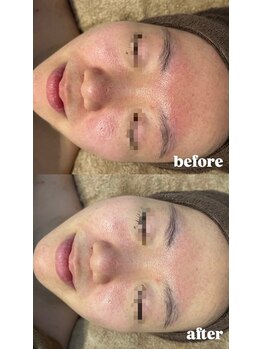 エクラ(ECLAT)/ピーリング×クールビタミン導入