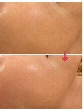 オンリーホープ(ONLY HOPE)/ララピール