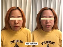 ナチュレアンドメディカ(Nature&Medica)/【たるみor小顔】オンダフェイス