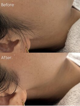 オスロ温サロン(OSLO.温salon)の写真/《フェイシャルワックス+エステ》肌ケアしながら産毛のない毛穴レスなもちもち＆うるツヤ美肌へ導きます♪