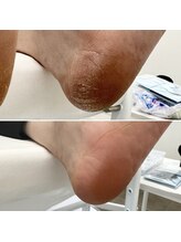 なかやまネイルクリニック/角質ケア