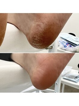 なかやまネイルクリニック/角質ケア