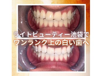 ライトビューティー 池袋店(LightBeauty)/症例写真